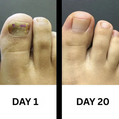 PureNail - Patented nail fungus therapy – for healthy nails within 4 weeks